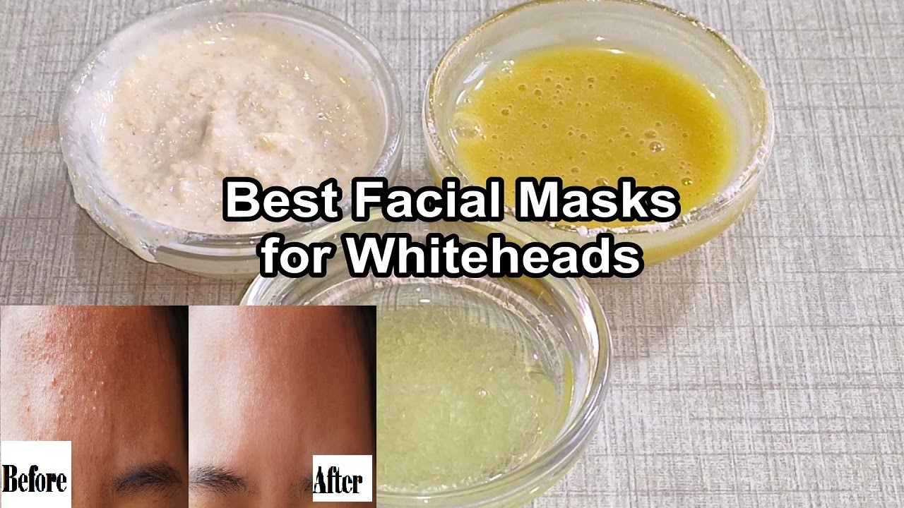 Easy Ways to Remove Whiteheads and Blackheads at Home How to remove