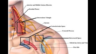 Thoracic Outlet Syndrome (TOS) vs Cervical Radiculopathy