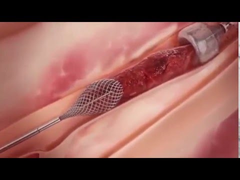 Удаление тромбов из артерии вакуумным методом.
