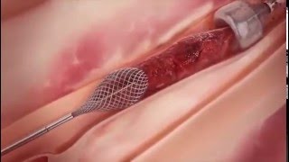 Удаление тромбов из артерии вакуумным методом.