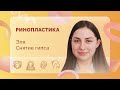 Ринопластика. Эля. 14 сутки после операции