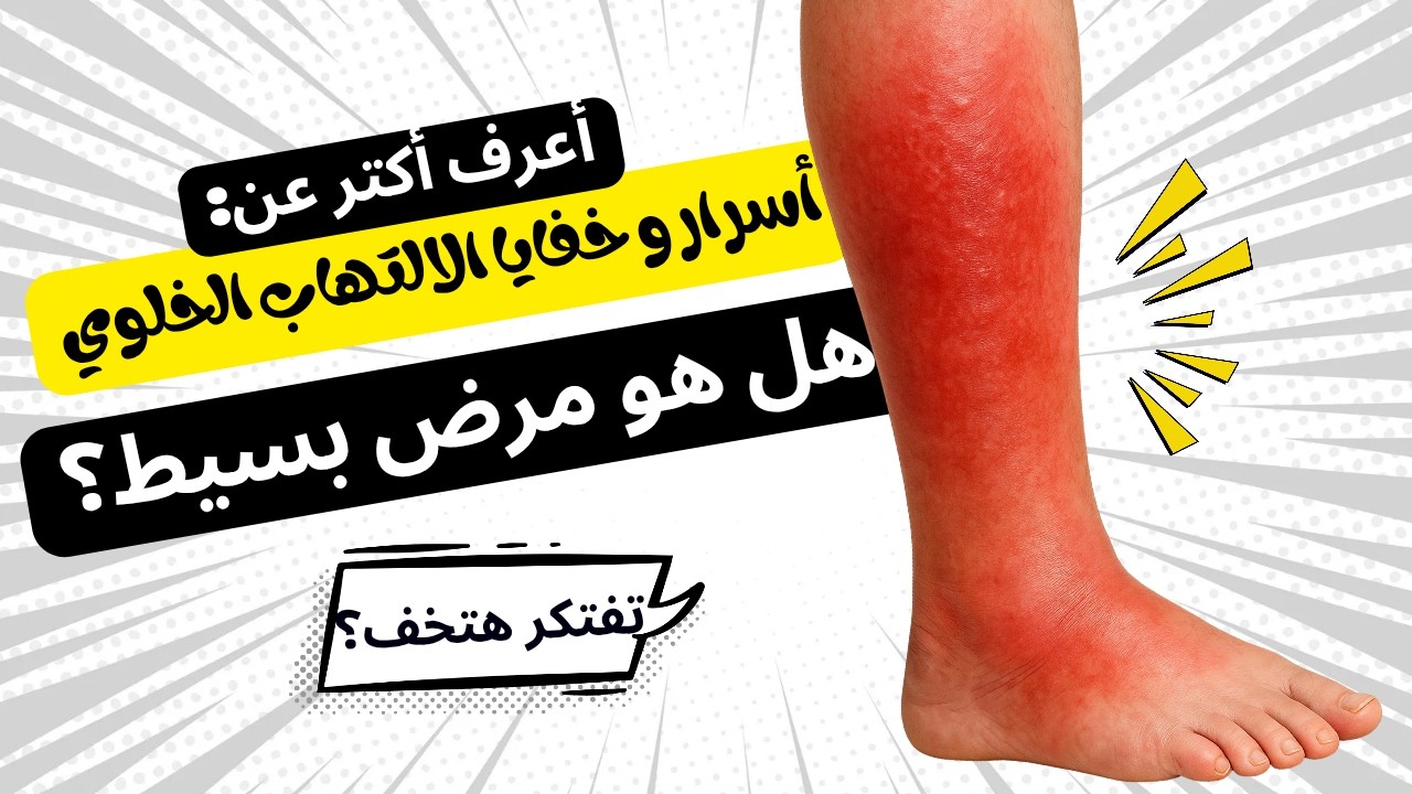 تورم الساق مش دايمًا دوالي... ممكن يكون التهاب خطير! II كواليس خطيرة عن الالتهاب الخلوي