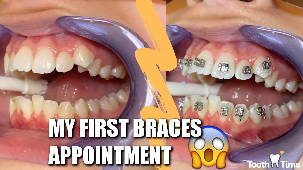 Braces Check up - Wire change 19x25 SS to 018SS - Tooth Time Family  Dentistry New Braunfels 