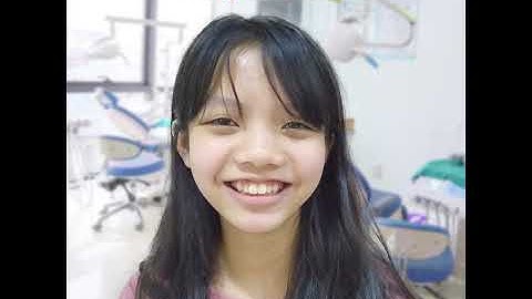 Niềng Răng Trong Suốt Invisalign Chỉ Từ 20 Triệu/ 2 Hàm