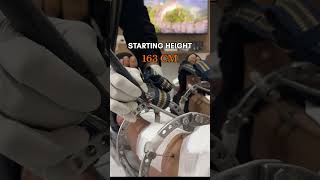 Limb Lengthening Surgery Height Increase Surgery In India