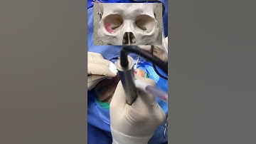 Scarless orbital decompression technique