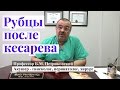 Рубцы после кесарева сечения - интервью с профессором Петриковским о родах в США