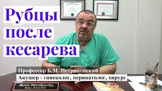 Рубцы после кесарева сечения - интервью с профессором Петриковским о родах в США