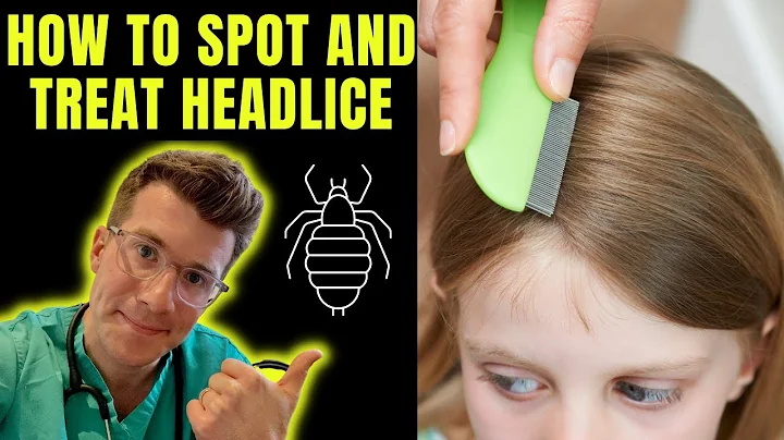 How to spot and treat Head lice (nits) | Doctor O'Donovan explains...