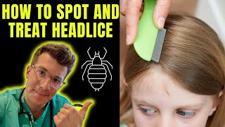 How to spot and treat Head lice (nits) | Doctor O