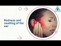ASOM Overcoming Acute Otitis Media Expert Advice For Effective Treatment ASOM Overcoming Acute Otitis Media Expert Advice For Effective Treatment