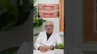 Dr. Brahme gives us the deets on the lip lift, which restores your smile in style! 😁✨