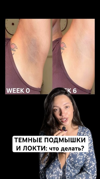 СЫВОРОТКА ОТ ТЕМНЫХ ПОДМЫШЕК 142052091 #темныеподмышки #пигментация # ...