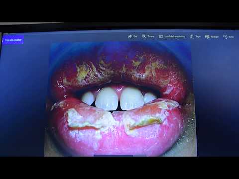 Como Cure esfoliativa Cheilitis Parte 1 de 5? Como Cure Descascar Lips?