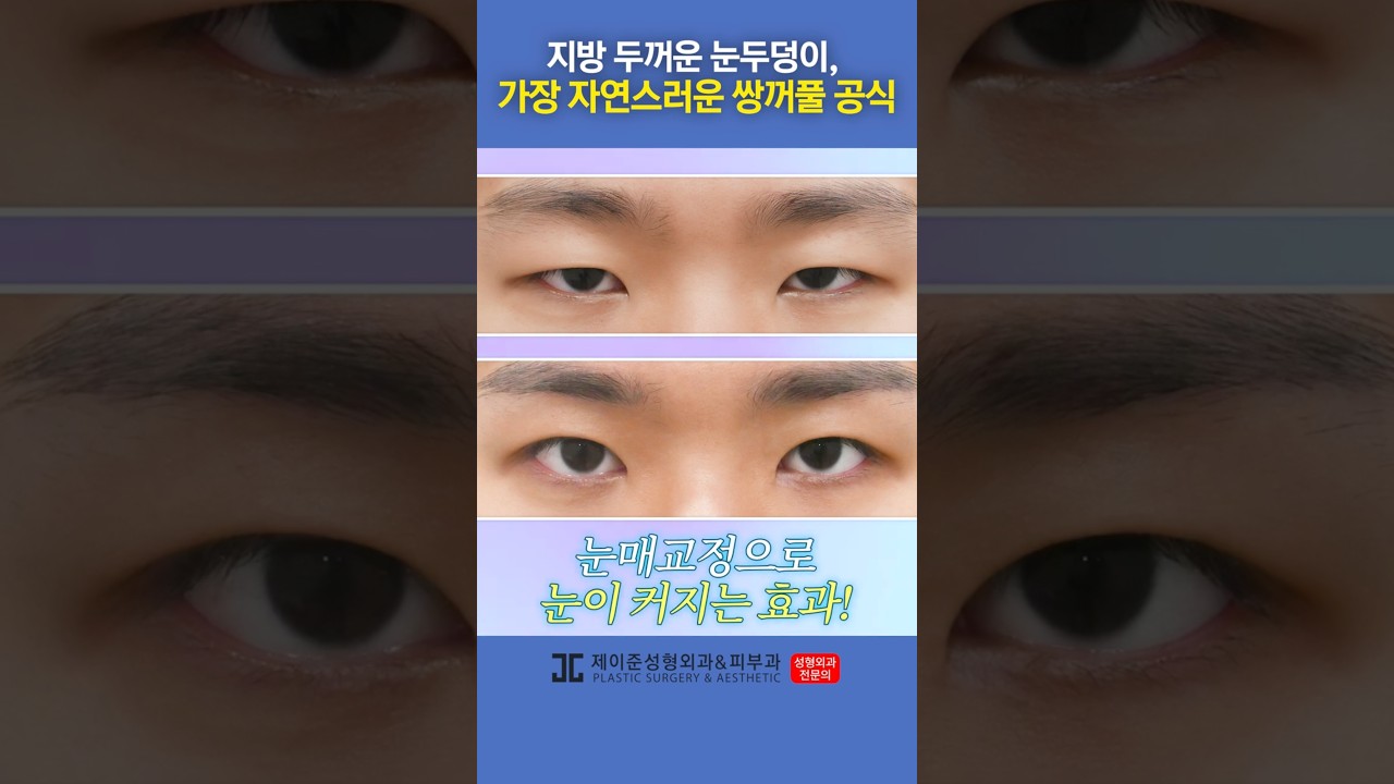 [Thẩm mỹ viện Jayjune Da liễu] Phương pháp phẫu thuật mí mắt giúp tạo đôi mắt đẹp mà không lo về phần mí trên #shorts