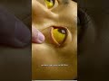 Gallbladder Surgery: Symptoms to Watch! #doctor #gallbladder #gallbladderhealth #gallbladderstones