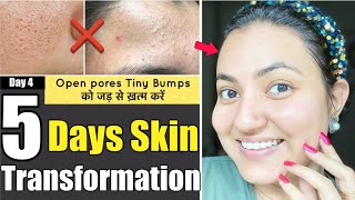 5 DAYS SKIN TRANSFORMATION CHALLENGE : Remove Tiny Bumps Open Pores/Clogged Pores in 5 Days screenshot 5