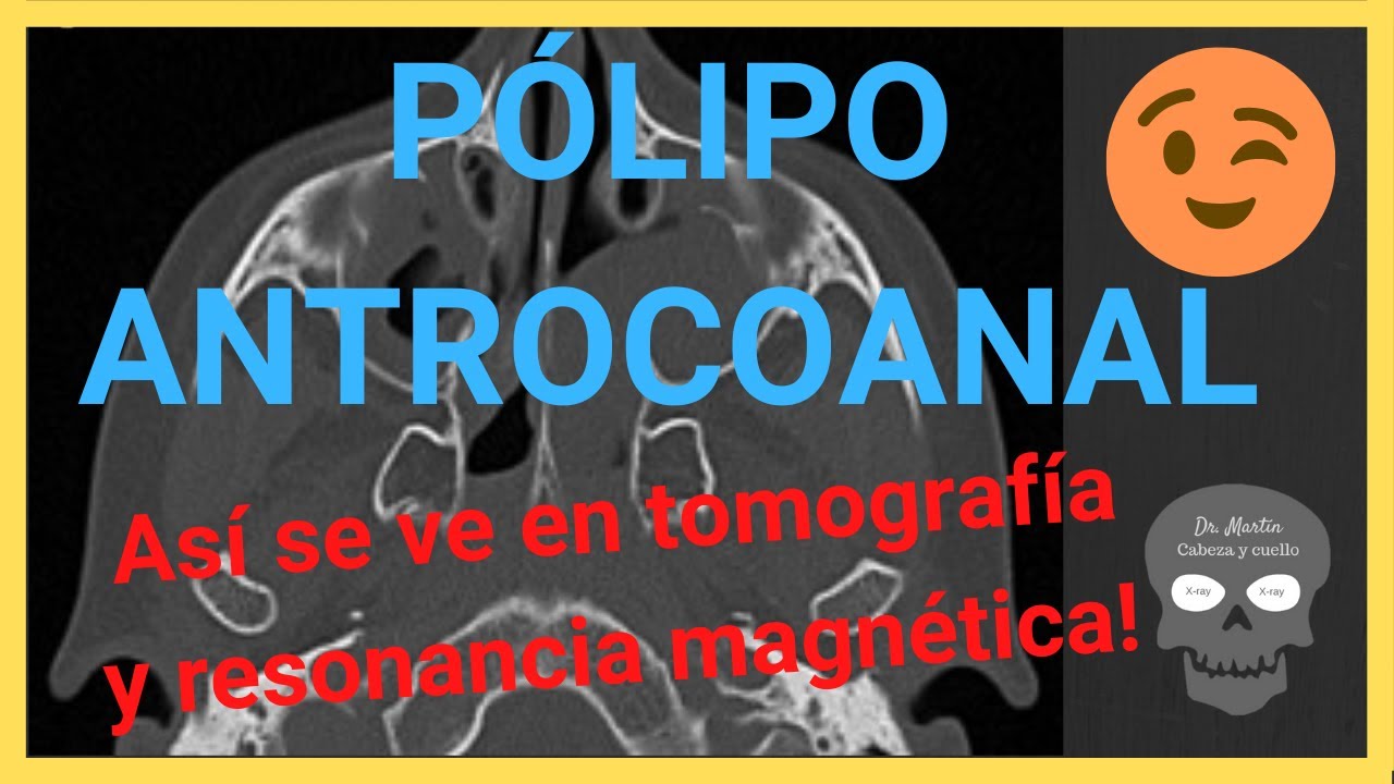 PÓLIPO ANTROCOANAL 👃[en tomografía y resonancia magnética]