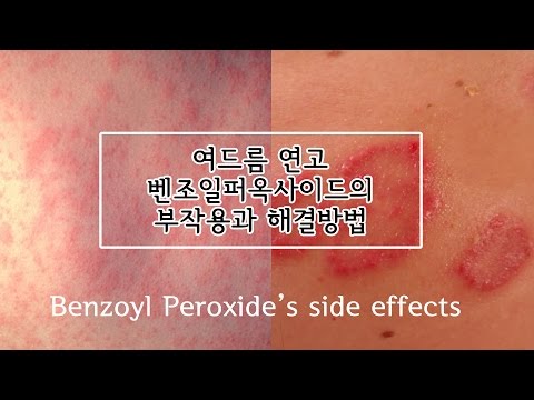 Benzoyl peroxide&rsquo;s side effects