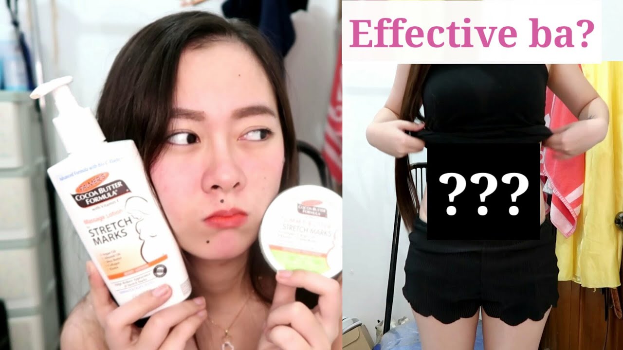 stretch mark removal cream in watsons