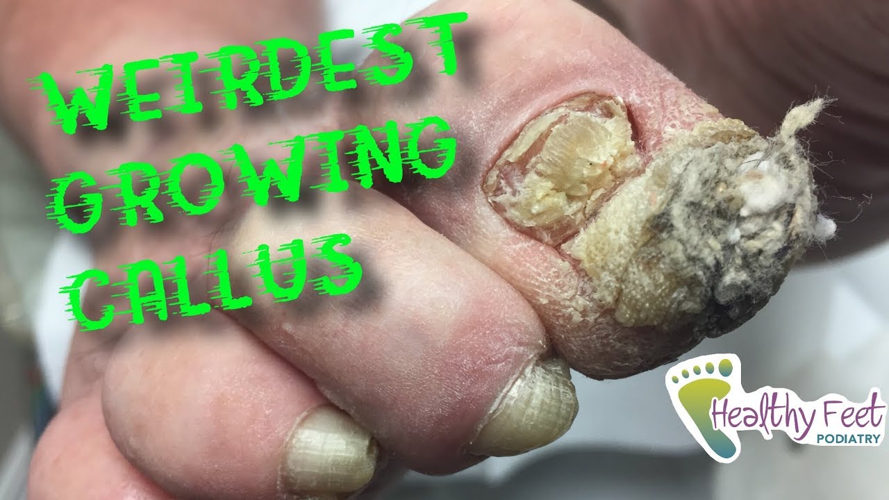Weirdest Growing Callus by Dr. Binh Nguyen. Large... - youtube