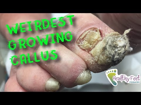 Video Weirdest Growing Callus by Dr. Binh Nguyen. Large... - youtube