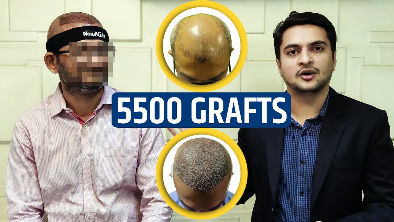 5500 Grafts Hair Transplant In India | Best Hair Transplant In Navi Mumbai |