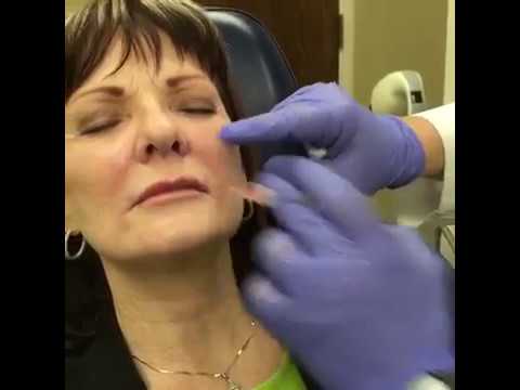 Restylane L Filler for Nasolabial Folds Wrinkle Treatment