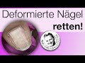 Deformierte Nagelplatte retten mit UV Gel