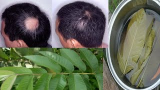 Alopecia Areata PODEROSO Remédio Indiano Para Alopecia Areata