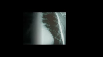 A Novel Transfer Learning Based Approach for Pneumonia Detection in Chest X-ray Images | RTCL.TV