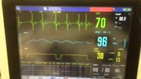 Maggie Barlow heart arrhythmia 2