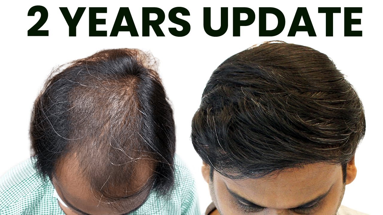 Hair Transplant Result After 2 Years | New Roots Hair Transplant Clinic ...