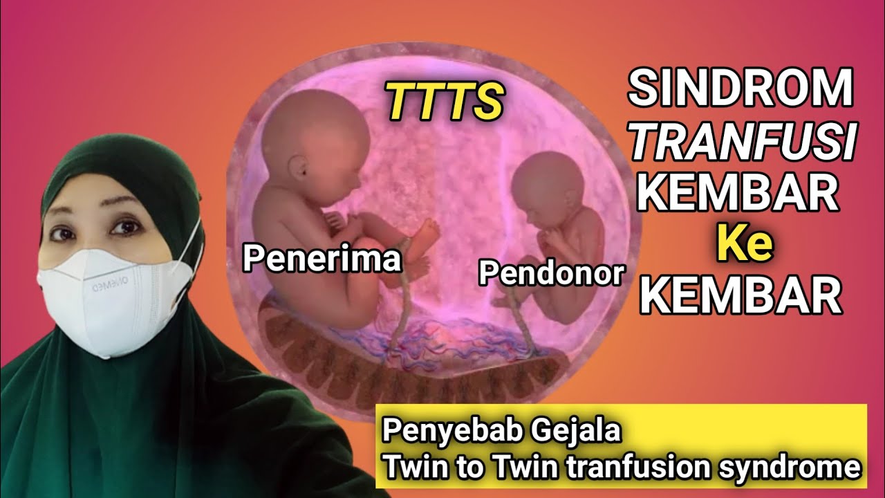 Anak kembar bisa saling tranfusi?? berikut PENYEBAB ANAK KEMBAR TIDAK SAMA BESAR  -TTTS