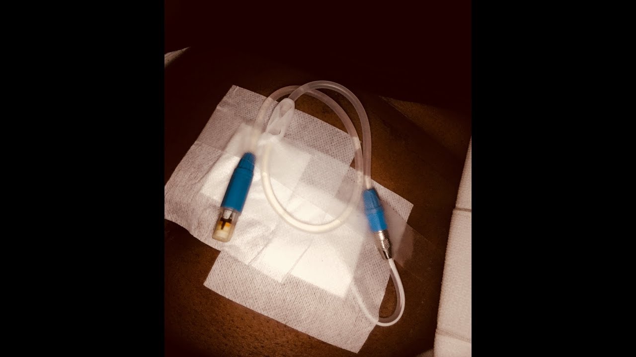 Peritoneal dialysis ,My 1st flush At Fresenius (Nalco Home Program