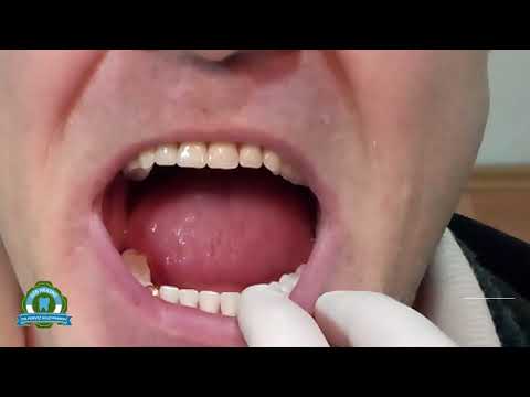 Protez Dişler - Diş Hekimi Perviz Suleymanov