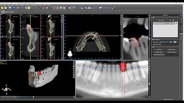 Segmenting Tooth from CT using Virtual Teeth