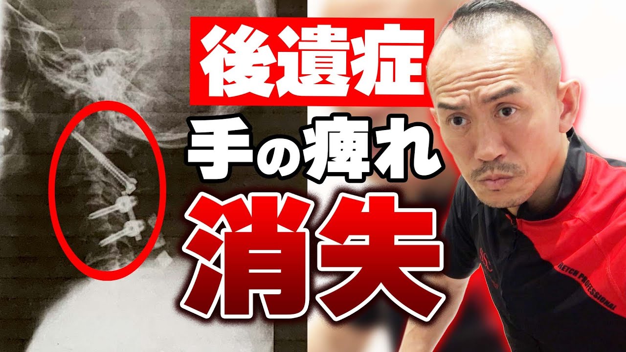 神経系モビライゼーション [上肢編]【DVD】Nerve Mobilization - YouTube