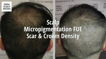 Scalp Micropigmentation FUE Scar & Crown Density Natural Result Hair Tattoo