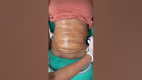 Abdomen Liposuction result | RF Session #shorts