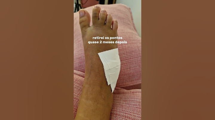 Fratura no 5 metatarso. quebrei o pé  #pes #neymar #fratura #fisioterapia #metatarso