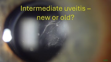 0059: Intermediate uveitis - new or old?