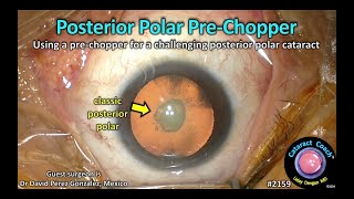 CataractCoach™ 2159: posterior polar pre-chopper