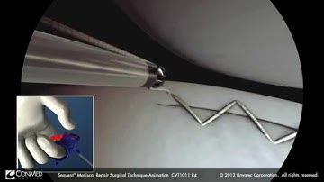 Sequent Surgical Technique video