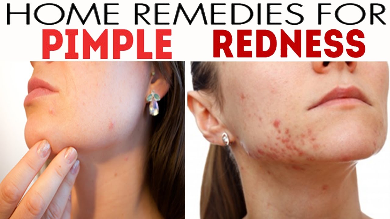 Home Remedies To Reduce Pimple Redness Youtube