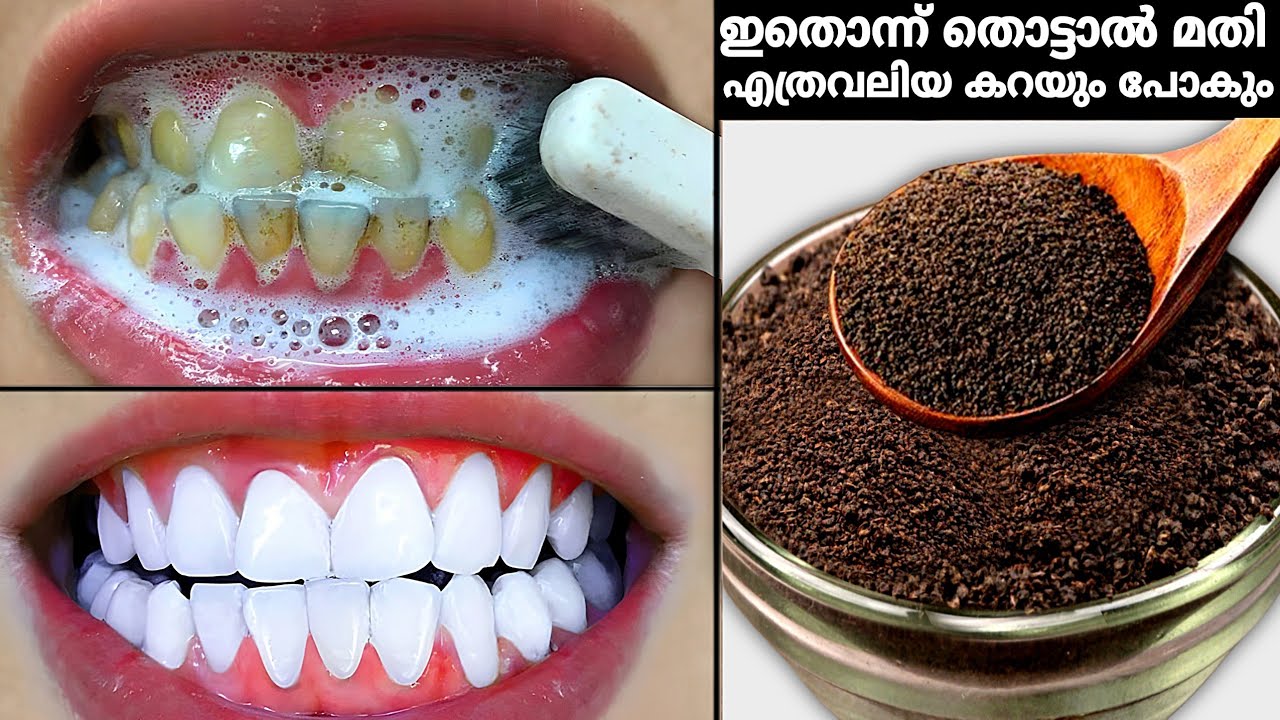 തേയില പല്ലിൽ തൊട്ടാൽ മതി,എത്ര കഠിന കറയും 1മിനിറ്റിൽ പമ്പകടക്കും! Teeth Whitening at Home