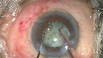 Demonstration of phaco surgery in a hard  leathery cataract with direct horizontal chop