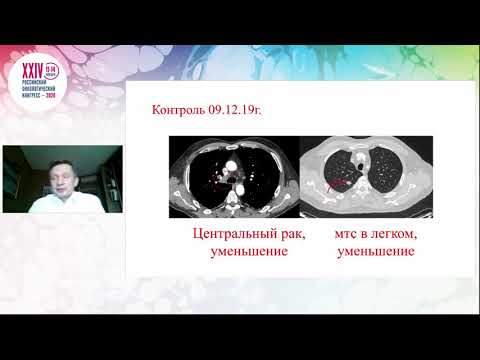 Videó: Az MDM2-gátló APG-115 Szinergizál A PD-1 Blokáddal Azáltal, Hogy Fokozza A Tumorellenes Immunitást A Tumor Mikrokörnyezetében