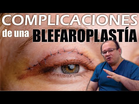5 COMPLICACIONES de una mala BLEFAROPLASTÍA👁️ Peligrosa Cirugía De Párpados 👀 Dr ALBERTO CALVO QUROZ