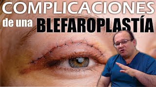 5 COMPLICATIONS of a Bad Blepharoplasty 👁️ Dangerous Eyelid Surgery 👀 Dr. Alberto Calvo Quroz